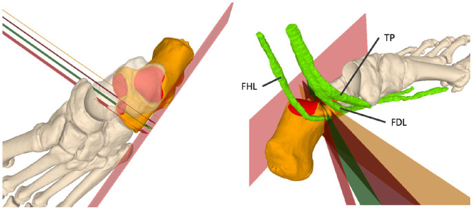 The Importance of the Entry Point and Osteotomy Direction in Calcaneal Lengthening Osteotomy.