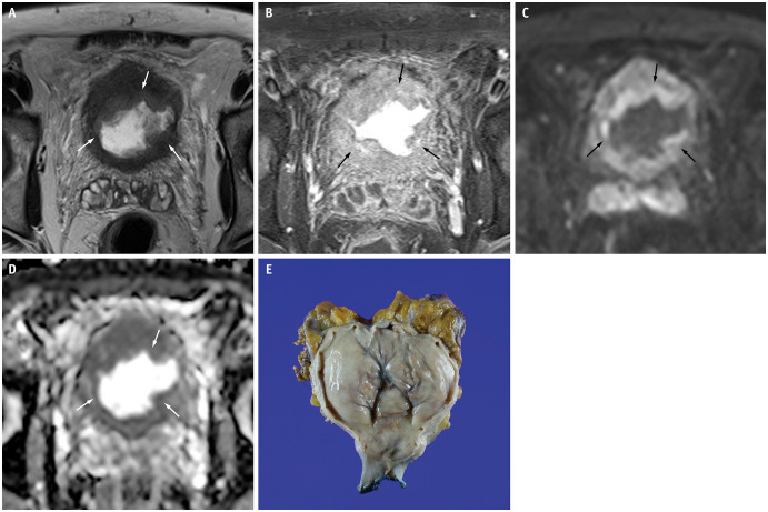 Multiparametric MRI Features of Plasmacytoid Urothelial Carcinoma of the Urinary Bladder.
