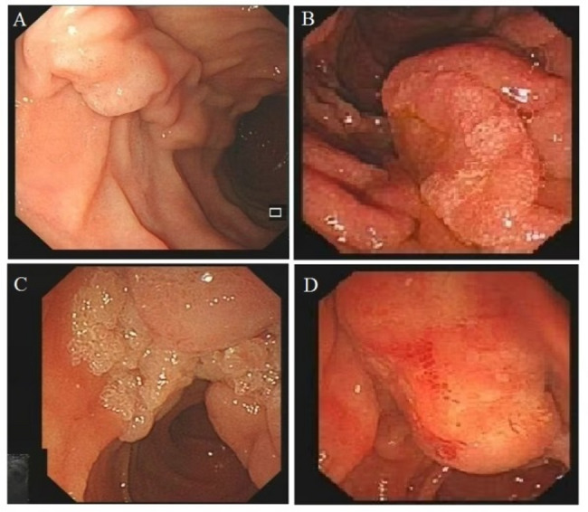 Histopathologic discrepancies between endoscopic forceps biopsy and resection specimens in duodenal papillary lesions: a retrospective study.