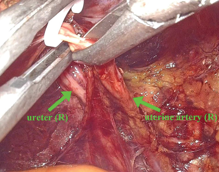 Mobilization and protection of the ureter during laparoscopic total hysterectomy for cervical fibroids.