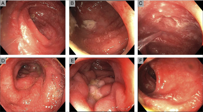 A Therapeutic Tightrope: Managing Coexisting Crohn Disease and Systemic Lupus Erythematosus With Risankizumab.