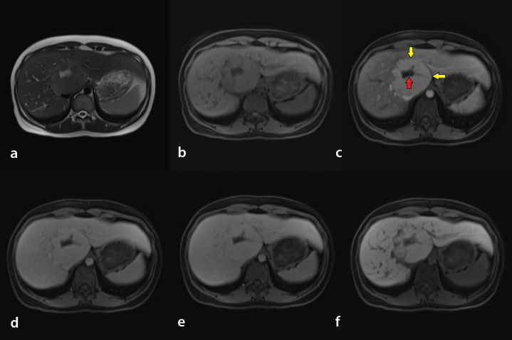 Evaluating artificial intelligence for a focal nodular hyperplasia diagnosis using magnetic resonance imaging: preliminary findings.