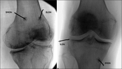 Outcome and predictors of knee radiofrequency ablation for chronic pain relief: A retrospective cohort study.