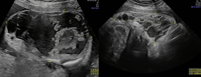 Effective Sirolimus Use in Prenatal and Postnatal Management of Symptomatic Extensive Congenital Capillary-Lymphatic-Venous Malformations (CLVMs): A Report of Two Cases.