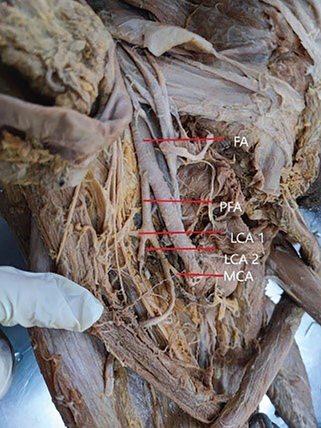 Unveiling the secrets of the profunda femoris artery: A cadaveric journey with morphometric insights.