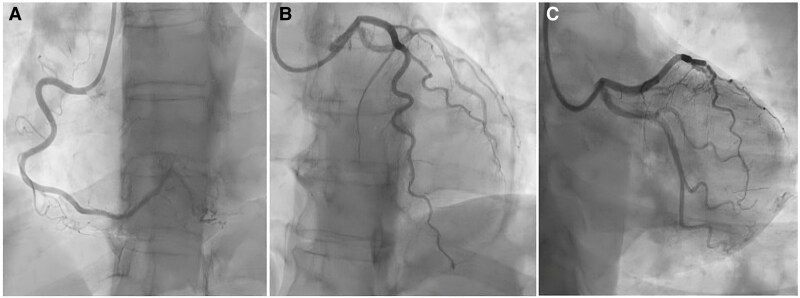 When chest pain is not what it seems: time for right diagnosis and right treatment-a case report.