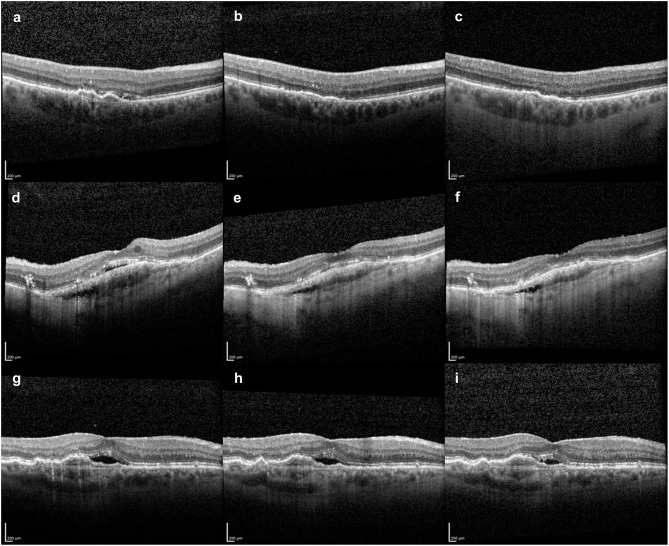 Additional Effects of Faricimab in Aflibercept Low-Responders: Retinal Morphology and Function in Eyes with Neovascular Age Related Macular Degeneration Following a Switch Between Two Anti-VEGF Agents.