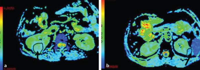 Diffusion kurtosis versus diffusion-weighted magnetic resonance imaging in differentiating clear cell renal cell carcinoma and renal angiomyolipoma with minimal fat: a comparative study.