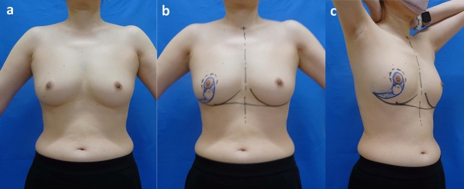 Oncoplastic breast-conserving surgery using a modified Grisotti's flap for a patient with central breast cancer in a non-ptotic breast.