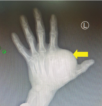 Synovial Sarcoma: Malignant Soft Tissue Sarcoma With Benign Clinical Characteristics-A Case Report.