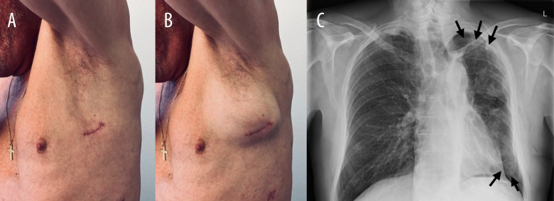 Postoperative Residual Pleural Space: A Risk Factor for Chest Wall Hernia After Thoracoscopic Surgery.