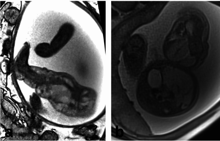 Effective Sirolimus Use in Prenatal and Postnatal Management of Symptomatic Extensive Congenital Capillary-Lymphatic-Venous Malformations (CLVMs): A Report of Two Cases.