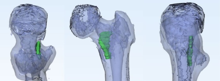 A Retrospective Study on the Relationship Between Calcar Femorale Injury and Postoperative Complications of Femoral Neck Fracture in Young and Middle-Aged Patients Treated With Three Cannulated Screws.