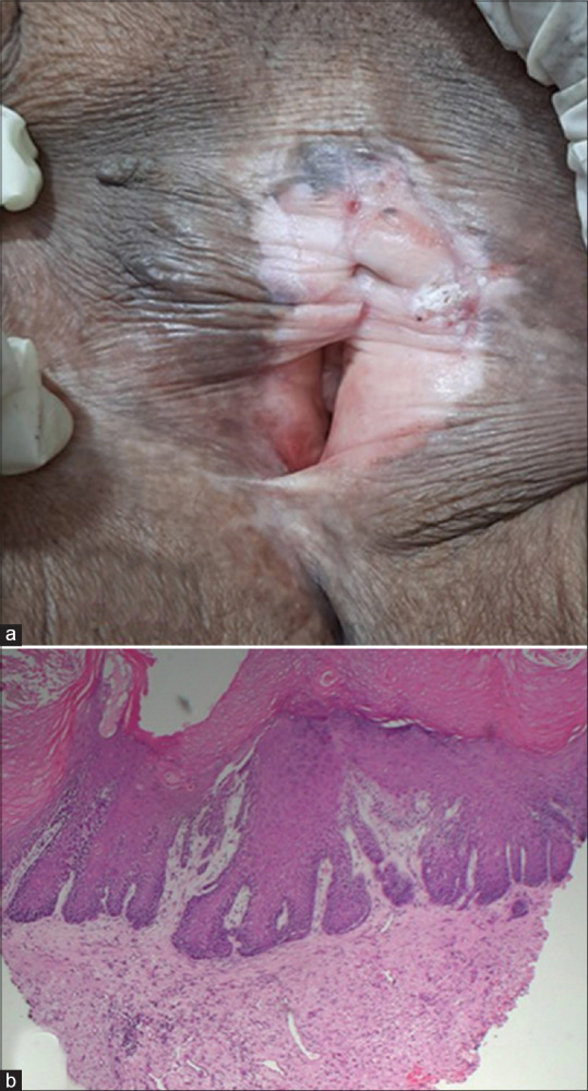 The Varying Faces of Vulvar Neoplasia.