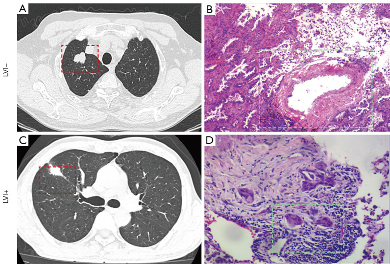 Development and validation of models based on clinical and CT features: multivariate analysis for predicting vascular invasion in non-small cell lung cancer.