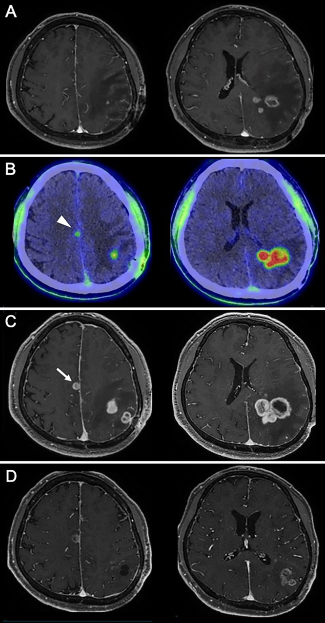 Identification of small distant glioblastoma lesions using 18F-fluciclovine positron emission tomography: illustrative case.