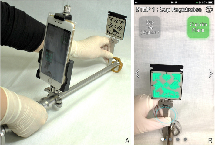 Accuracy of cup positioning of a non-invasive augmented reality-based navigation system for total hip arthroplasty in the supine position.