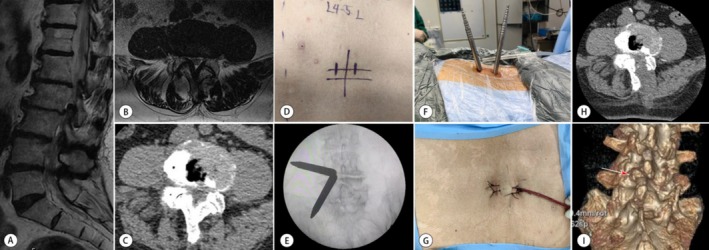 Perioperative Enhanced Recovery After Surgery (ERAS) Clinical Pathway for Unilateral Biportal Endoscopy with Unilateral Laminotomy for Bilateral Decompression.