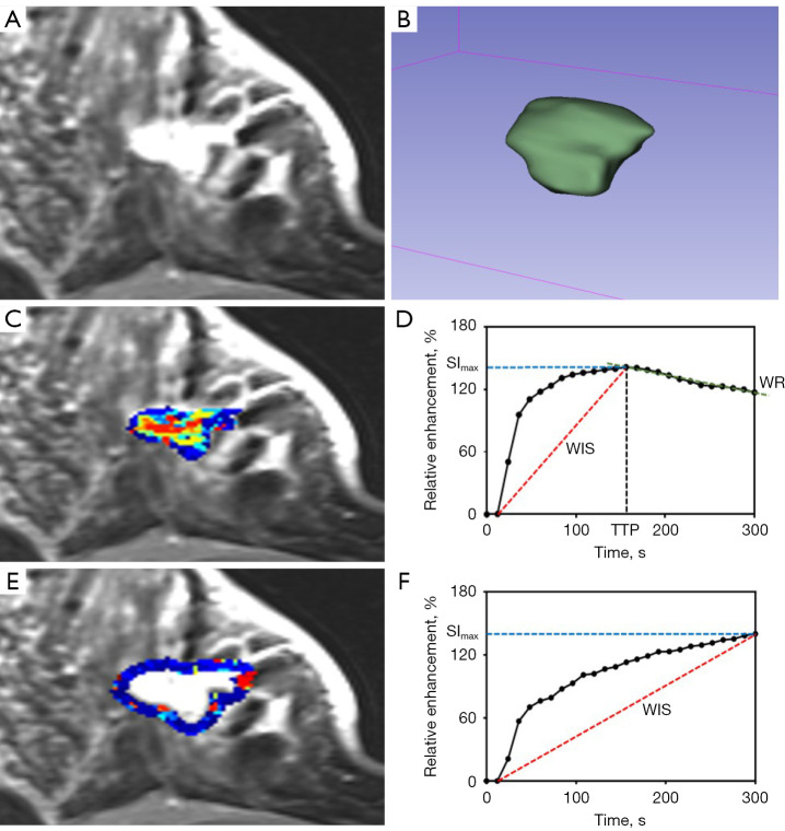 Development of a prediction model for HER2 low breast cancer using quantitative intra- and peri-tumoral heterogeneity and MRI features on high-spatial resolution ultrafast DCE-MRI.