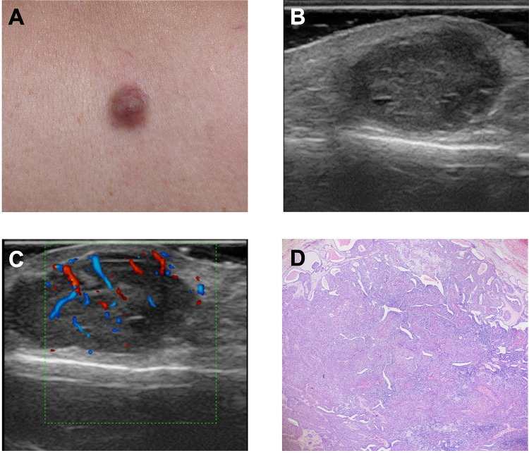 Very-High-Frequency Ultrasonographic Profiling Characteristics of Nodular Hidradenoma: A Retrospective Analysis.