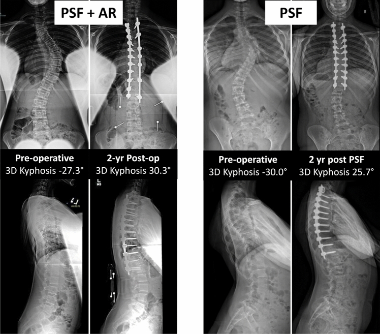 Anterior release is not needed to restore kyphosis in moderate AIS with hypokyphosis.