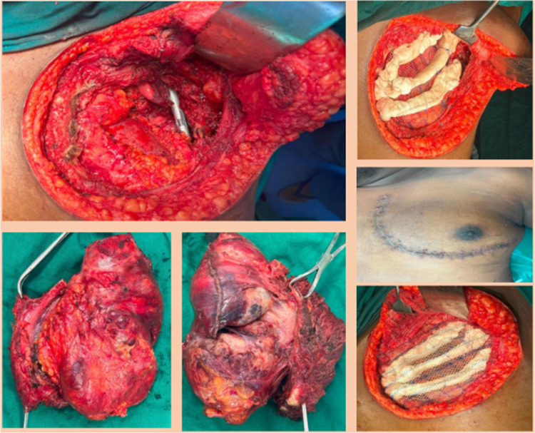 Short-term outcomes of chest wall resections.