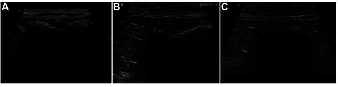 GS-441524 Treatment in a Cat With Feline Infectious Peritonitis Virus and Pyogranulomatous Transverse Colon Lesion.