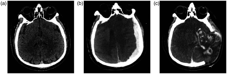 A fatal case report of <i>Plasmodium falciparum</i> malaria complicated by acute subdural hematoma.