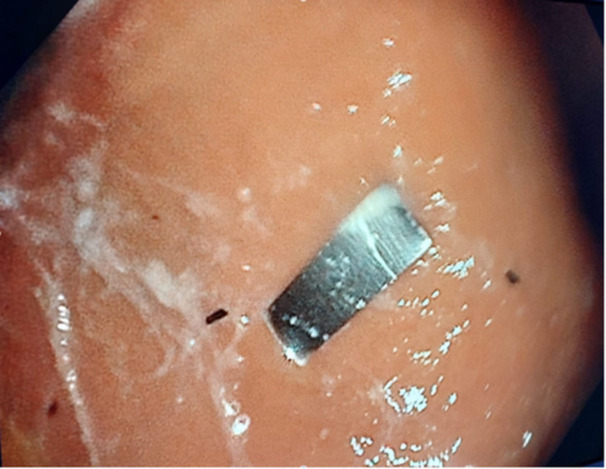 Metallic plate in tobacco filters: A new pediatric challenge.