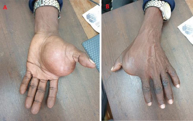 Synovial Sarcoma: Malignant Soft Tissue Sarcoma With Benign Clinical Characteristics-A Case Report.