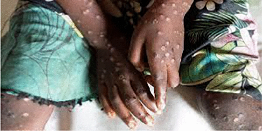 Harnessing community-based one health interventions implementation beyond Mpox outbreak management in Africa: insights and benefits.
