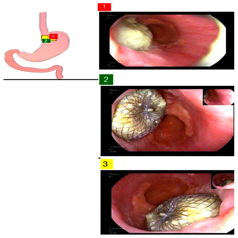 Innovative Use of Atrial Septal Defect Occluders for Gastric Leak Management After Sleeve Gastrectomy: A Case Report.
