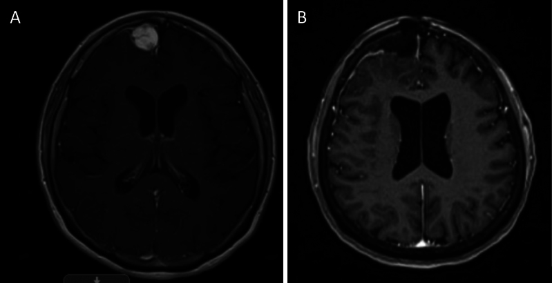 Myxoid spindle cell neoplasm with FET::CREB fusion mimicking meningioma: illustrative case.