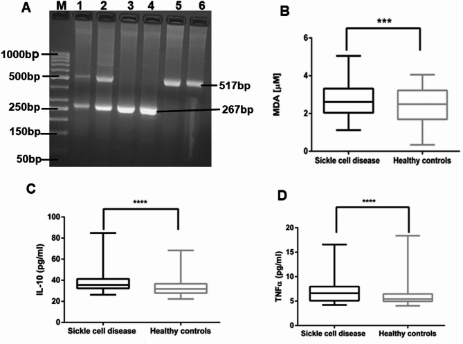 IL10 (-1082 G>A, rs1800896) gene polymorphisms are associated with oxidative stress in sickle cell disease patients in Uganda.