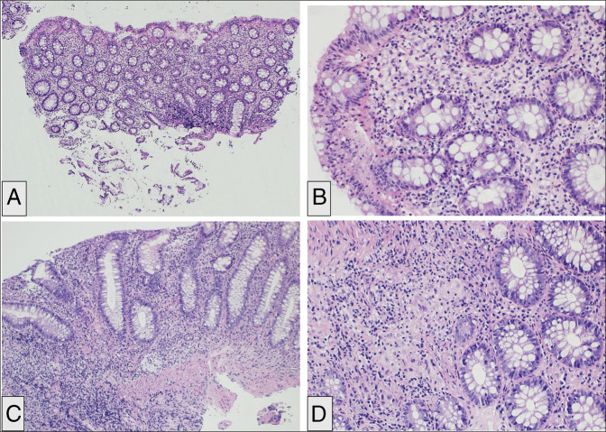 A Therapeutic Tightrope: Managing Coexisting Crohn Disease and Systemic Lupus Erythematosus With Risankizumab.