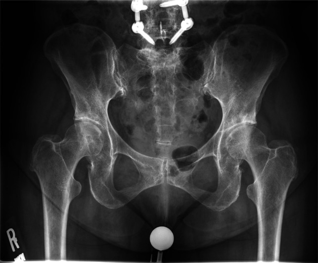 Bilateral Osteonecrosis of the Femoral Head and Proximal Femur After Corticosteroid Injections: A Case Report.