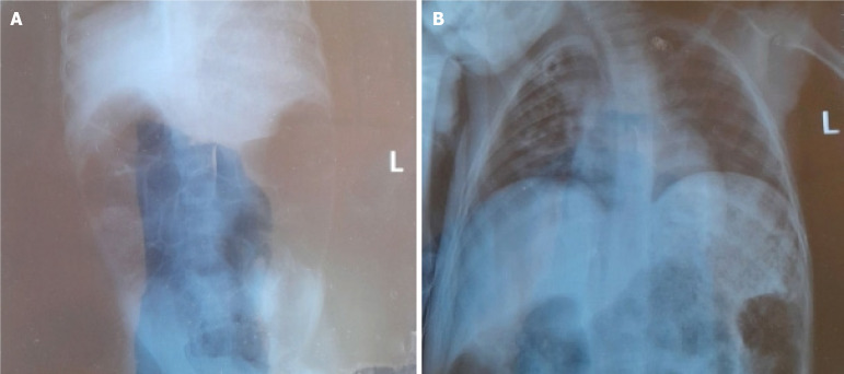 Organophosphate poisoning presenting with paralytic ileus: A case report.