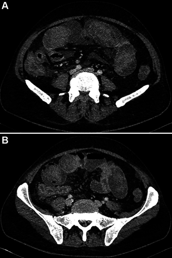 Neutropenic Enterocolitis in Acute Myeloid Leukemia and Morbus Behcet: Pivotal Role of Medical Imaging and Multidisciplinary Management in a Complex Clinical Case.