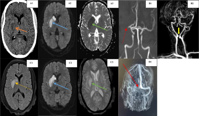 Protein S deficiency manifesting with cerebral arterial and venous thrombosis in a young female with kissing carotids phenomenon.