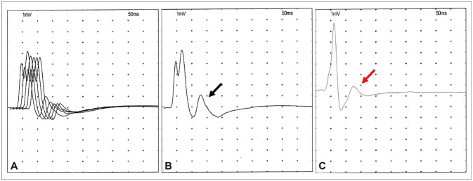 Slow-Channel Congenital Myasthenic Syndrome Due to <i>CHRND</i> Mutation in South Korea.