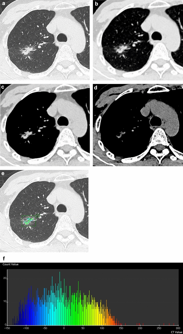 Qualitative and quantitative CT analyses of the solid component in lung adenocarcinoma for predicting invasiveness.