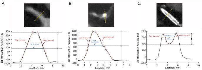 Improved image quality and diagnostic performance of coronary computed tomography angiography-derived fractional flow reserve with super-resolution deep learning reconstruction.