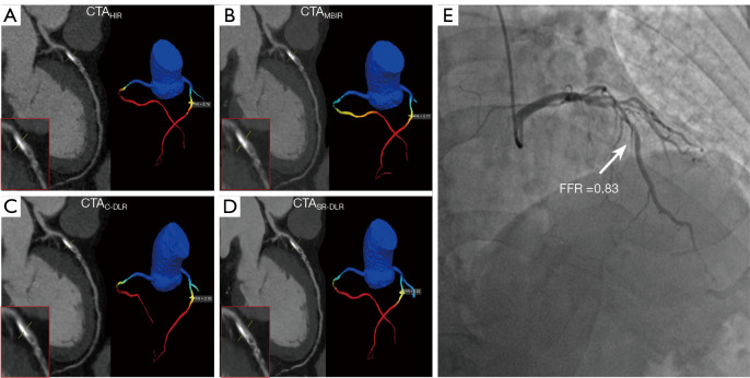 Improved image quality and diagnostic performance of coronary computed tomography angiography-derived fractional flow reserve with super-resolution deep learning reconstruction.