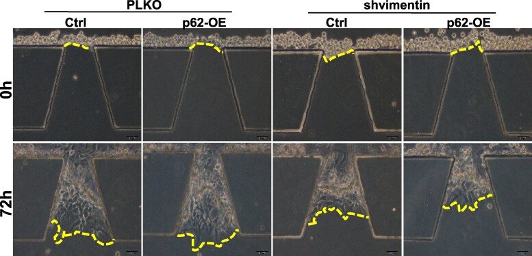 Correction to: p62/SQSTM1 interacts with vimentin to enhance breast cancer metastasis.
