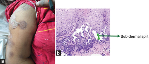 A case series of vildagliptin-associated bullous pemphigoid - Rare side effect.