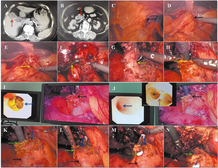 Challenges of minimally invasive treatment for acute obstructive suppurative cholangitis in elderly patients.