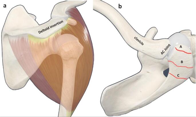 Functional outcomes and complications of classic grammont-style reverse shoulder arthroplasty in patients with os acromiale: a retrospective case-control study.