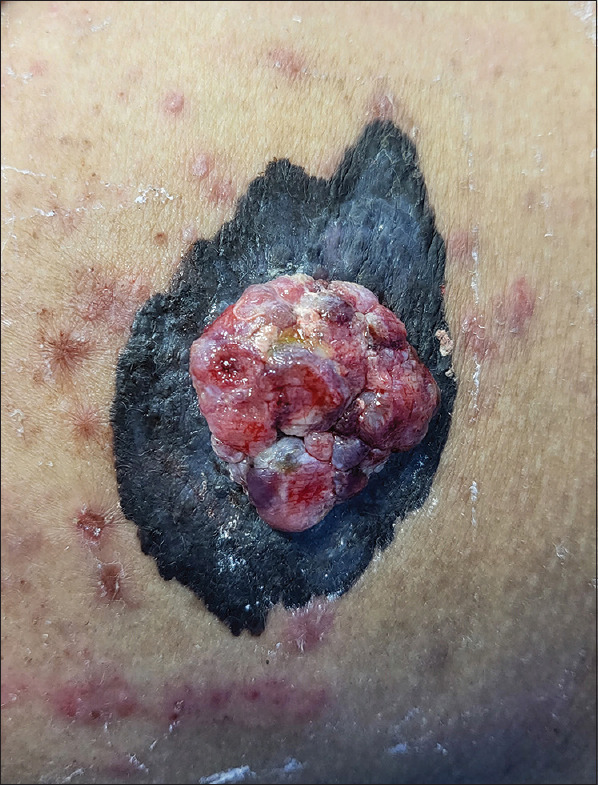 Nodular Melanoma.