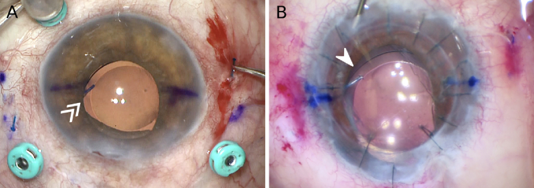 Haptic-Optic Fractures in Yamane Flanged Intrascleral Fixated Lenses: A Case Series.