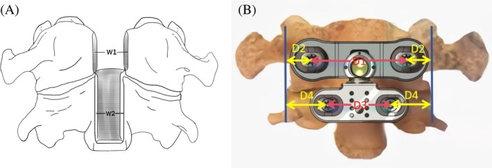 Design of a Novel Artificial Atlanto-Odontoid Joint and Its Anatomical and Radiological Studies Following Transoral Pharyngeal Approach Arthroplasty.